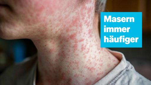 logo! vom 14. März 2025 - Thumb | Rechte: ZDF Bild von Kind mit Masern