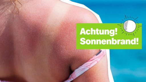 Kind mit Sonnenbrand am Rücken
